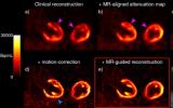 同步PET-MR成像可以改善心脏病的诊断