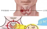 刘超：放射性核素碘-131治疗的甲癌患者心理疏导 