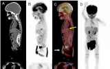 丹麦研究人员在儿童无镇静状态下进行5分钟全身PET/CT测试