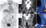 李周雷：FDG PET误诊食管癌的异位乳头状甲状腺癌的病例报道
