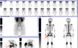 儿童骨骼照妖镜——核素全身骨显像