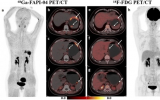 研究人员寻求PET/CT在胃癌中的作用