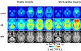 脑PET成像揭示血清素在阿尔茨海默病中的作用