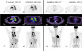 PET/MRI有望成为淋巴瘤诊断中PET/CT的有效替代方案