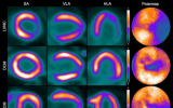 FAPI-PET显示了可视化心肌病的前景