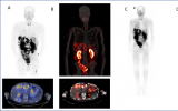 SNMMI年度影像：新的治疗诊断学有助于胰腺癌的早期检测和有效治疗