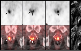 新型PET放射性示踪剂可否成为多参数MRI的可行替代方案，检测前列腺癌复发？